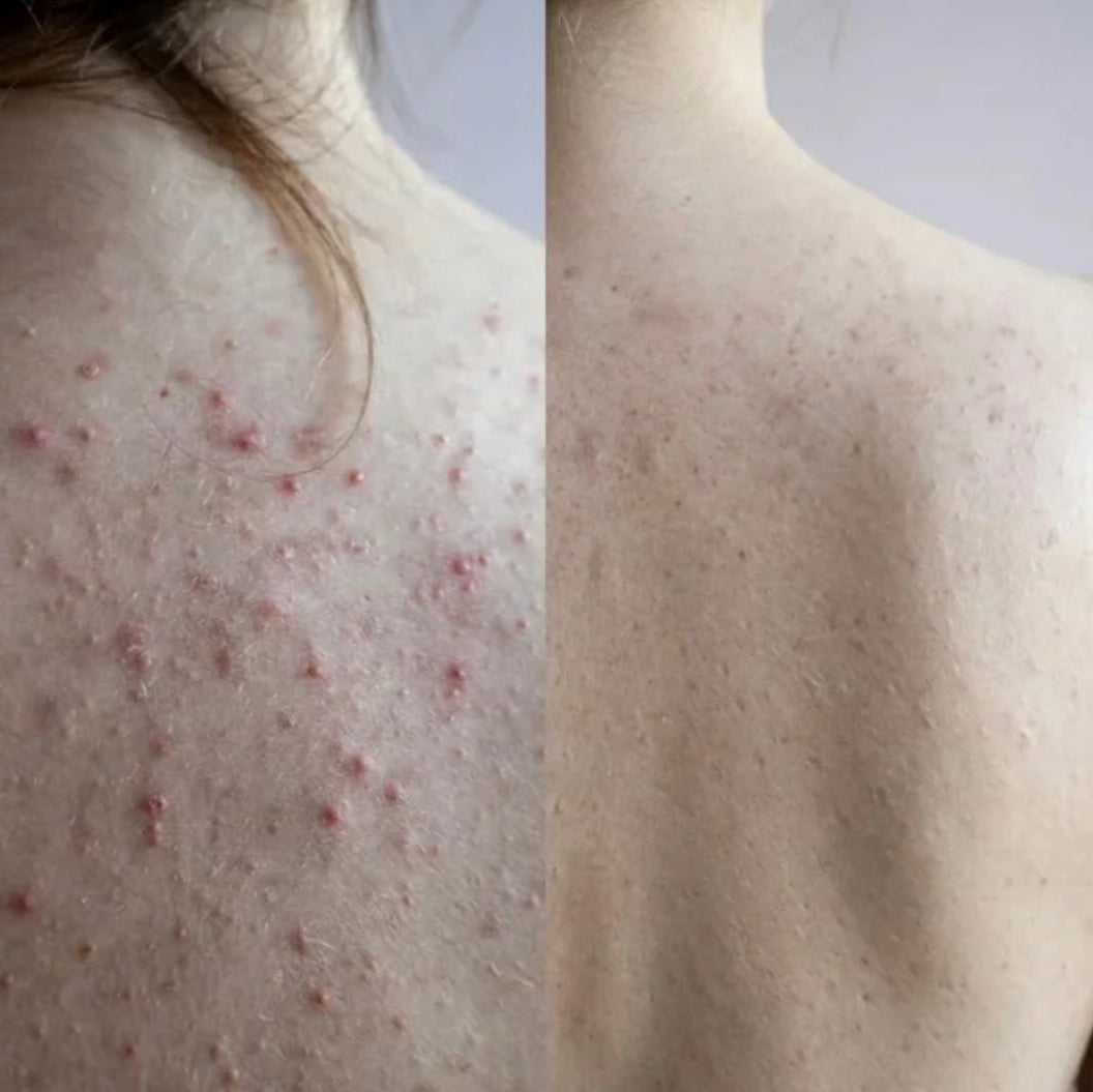 Acne Collagen Gummies.