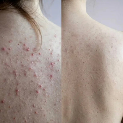 Acne Collagen Gummies.