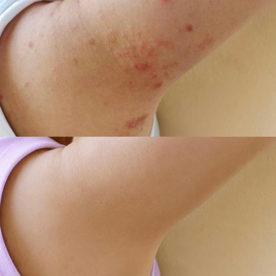 Acne Collagen Gummies.