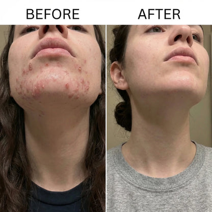 Acne Collagen Gummies.