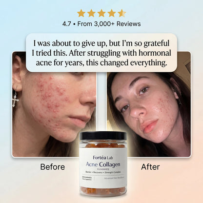 Acne Collagen Gummies.