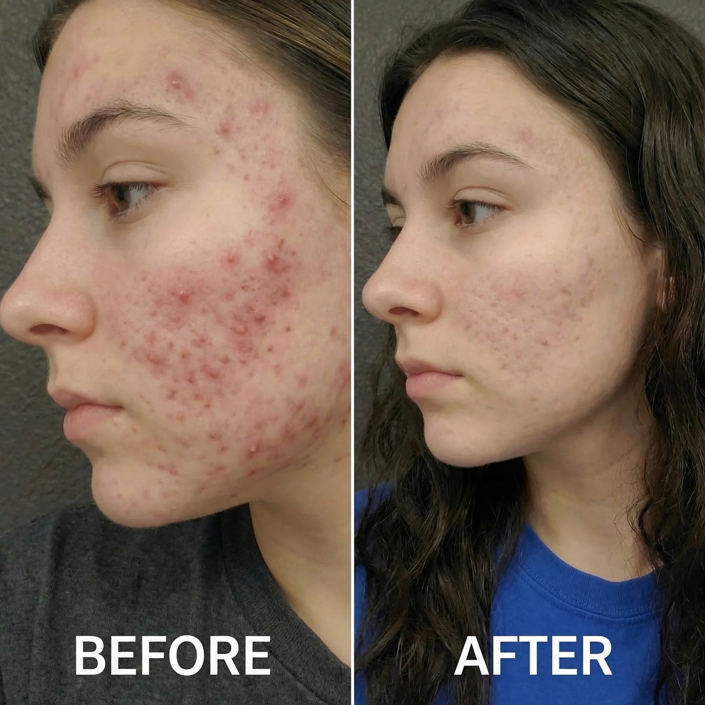 Acne Collagen Gummies.
