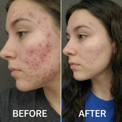 Acne Collagen Gummies.