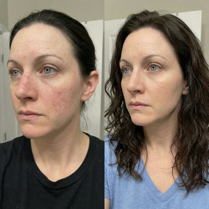 Acne Collagen Gummies.