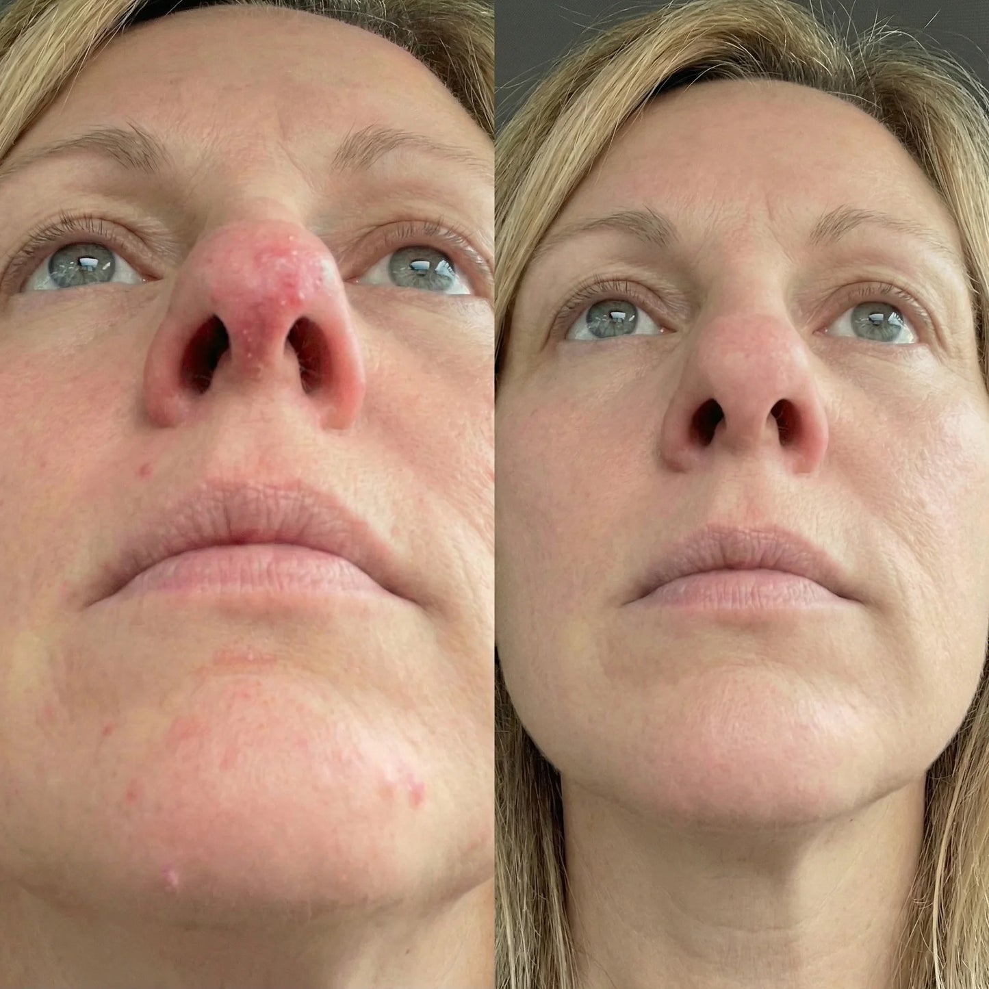 Acne Collagen Gummies.