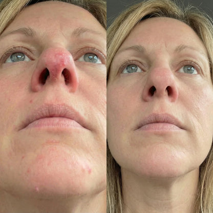 Acne Collagen Gummies.